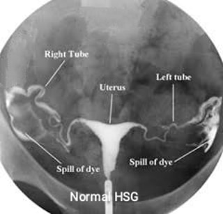 Hysterosalpingogram! By Dr. Suyash Bhandekar Lybrate