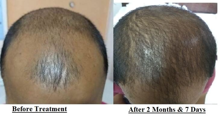 Hair loss - Ways To Deal With It! - By Dr. Izhar Hasan | Lybrate