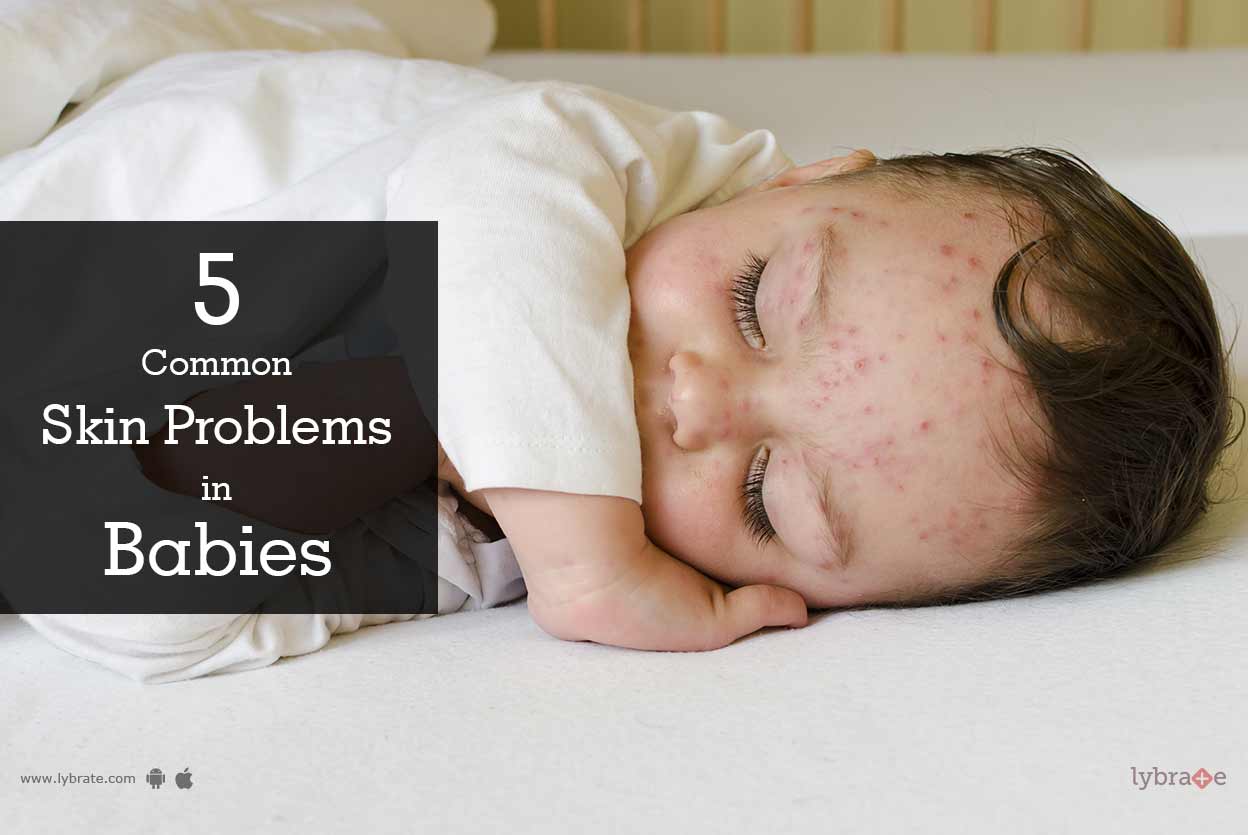 5 Common Skin Problems in Babies By Dr. Ranjan Upadhyay Lybrate