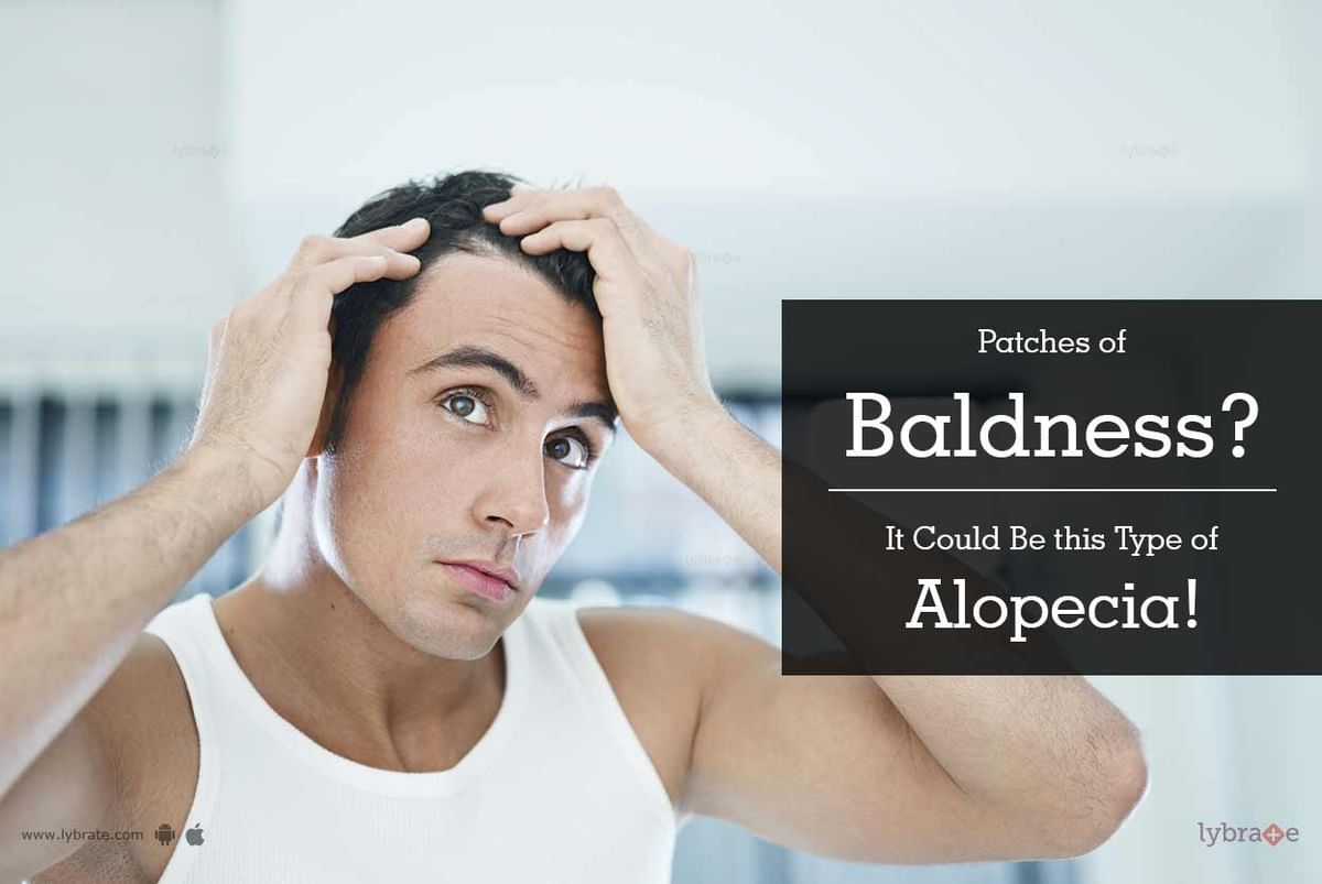 Patches of Baldness? It Could Be this Type of Alopecia! - By Richfeel |  Lybrate