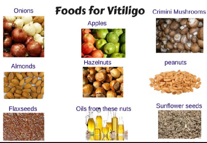 diet-for-vitiligo-by-dt-neha-suryawanshi-lybrate