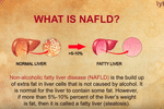 What is non-alcoholic fatty liver disease (nafld)