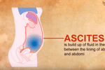 Ascites - what is it?