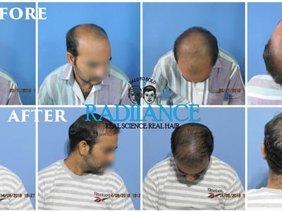 Radiance Advanced Hair Transplant Center, Hair loss, Hair fall, Treatment,  Hospital, Clinic in Ameerpet, Hyderabad - Book Appointment, View Contact  Number, Feedbacks, Address | Dr. Krishna Priyaa Ch