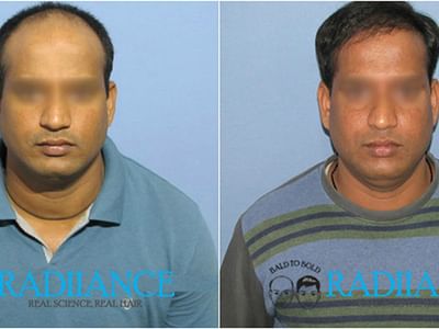 Radiance Advanced Hair Transplant Center, Hair loss, Hair fall, Treatment, Hospital, Clinic in Ameerpet, Hyderabad - Book Appointment, View Contact Number, Feedbacks, Address | Dr. Krishna Priyaa Ch Radiance Advanced Hair Transplant Center, Hair loss, Hair fall, Treatment, Hospital, Clinic in Ameerpet, Hyderabad - Book Appointment, View Contact Number, Feedbacks, Address | Dr. Krishna Priyaa Ch