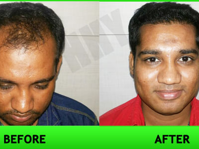 Hair Transplant In Guwahati at Hair Harmony and You Hair Transplant Clinic   YouTube