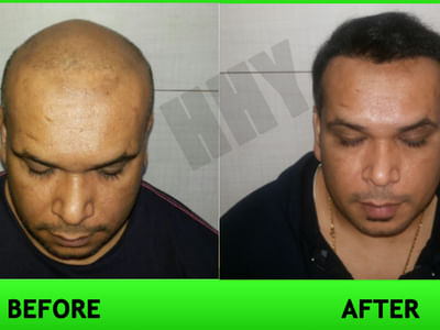 Pin on Best Hair Transplant Clinic India