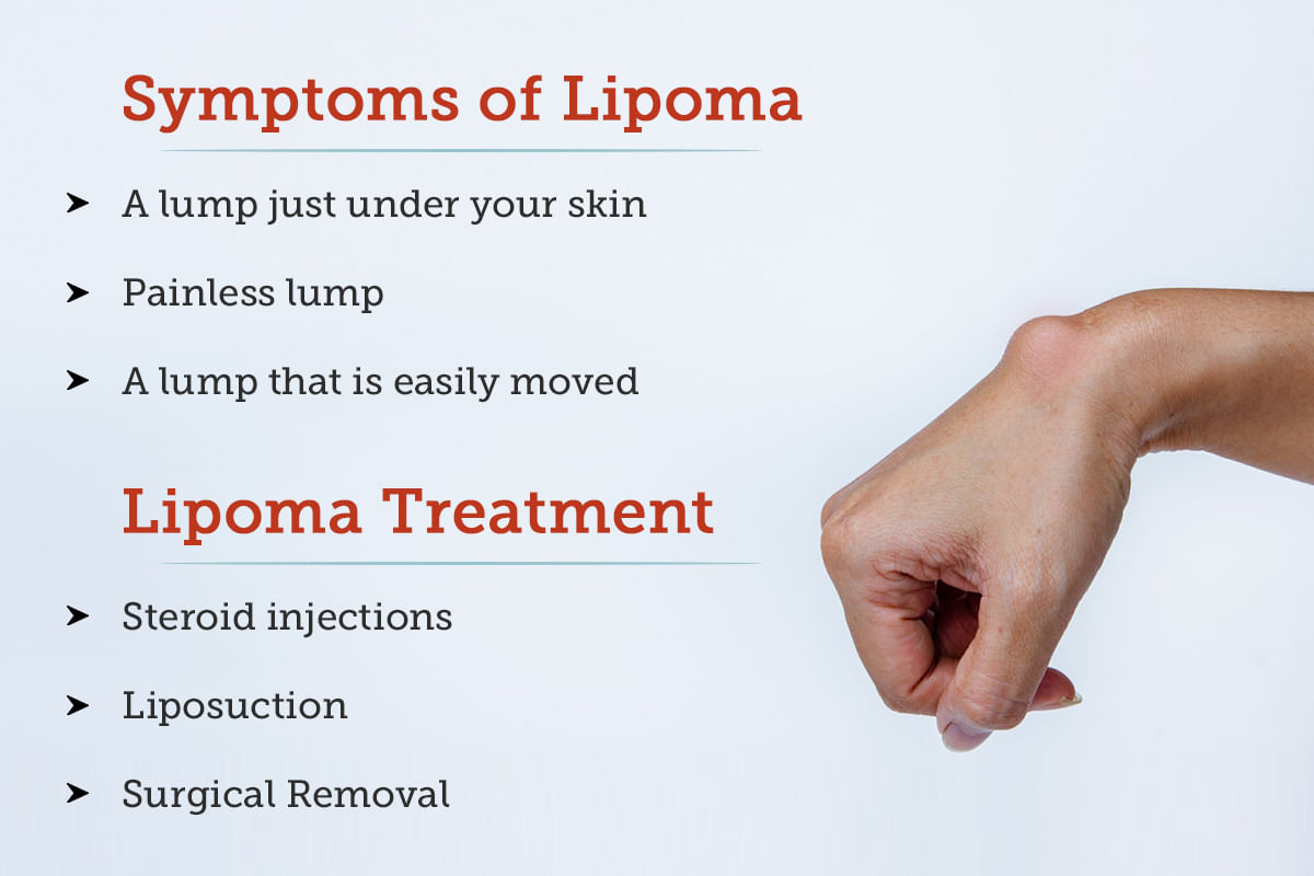 Meaning Of Lipoma In Urdu And English Age Infoupdate