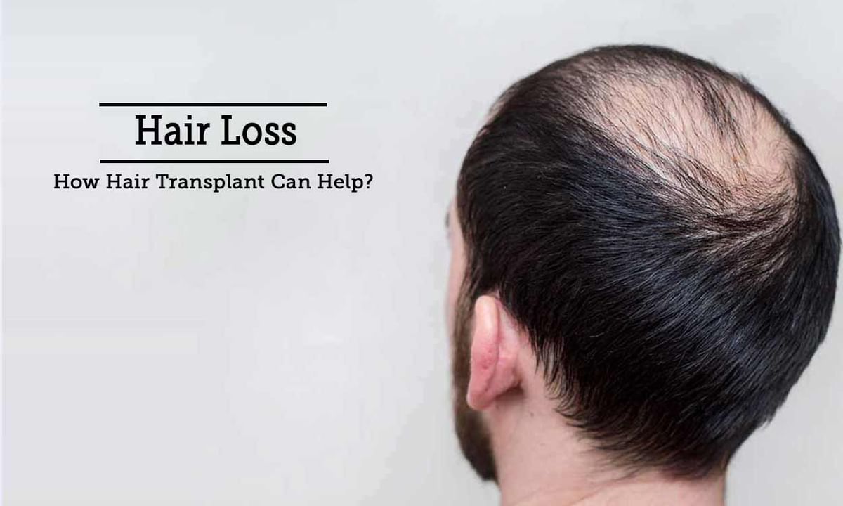 FUE Hair Transplant - Articles & Health Tips, Questions & Answers, Advice  From Top Doctors, Health Experts | Lybrate