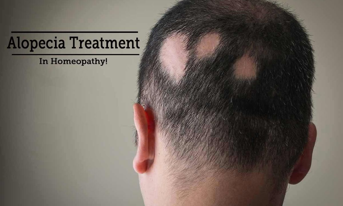Alopecia Areata Treatment Tips & Advice From Top Doctors | Lybrate