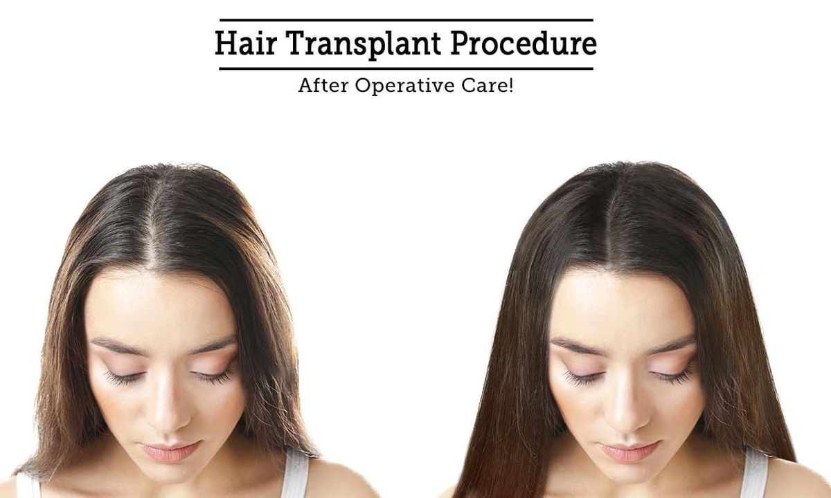 Hair Transplant Tips & Advice From Top Doctors | Lybrate