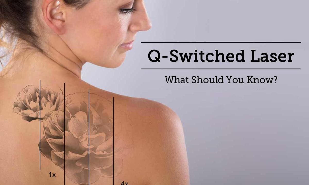Disco Elastisch wrijving Q-Switched Laser - What Should You Know? - By Dr. Nivedita Dadu | Lybrate