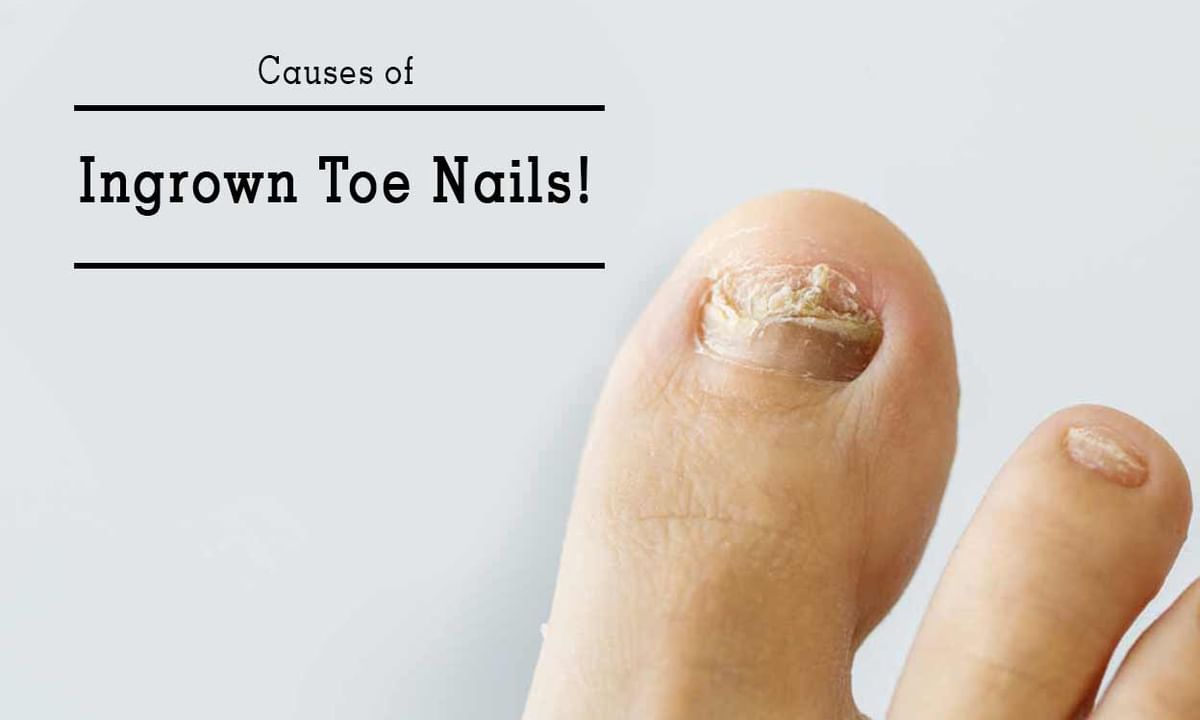 Nail infection Tips & Advice From Top Doctors | Lybrate Nail infection Tips & Advice From Top Doctors | Lybrate