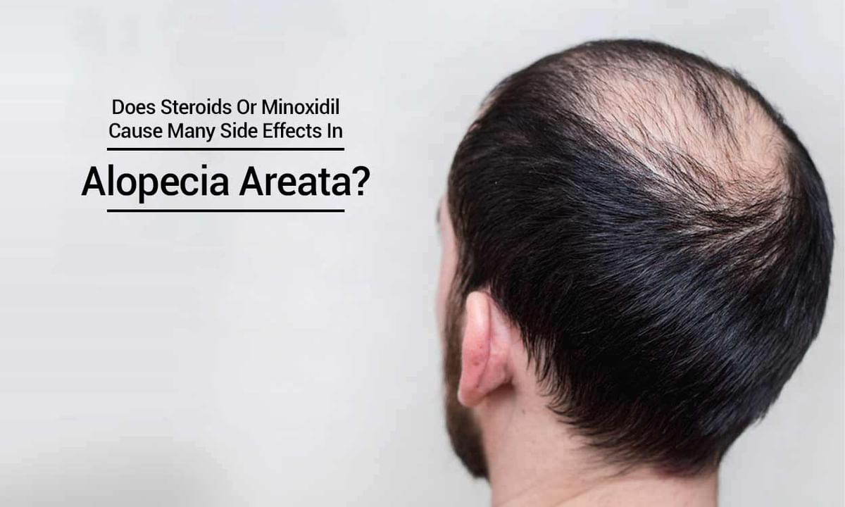 seksuel Sequel rack Does Steroids Or Minoxidil Cause Many Side Effects In Alopecia Areata? |  Lybrate