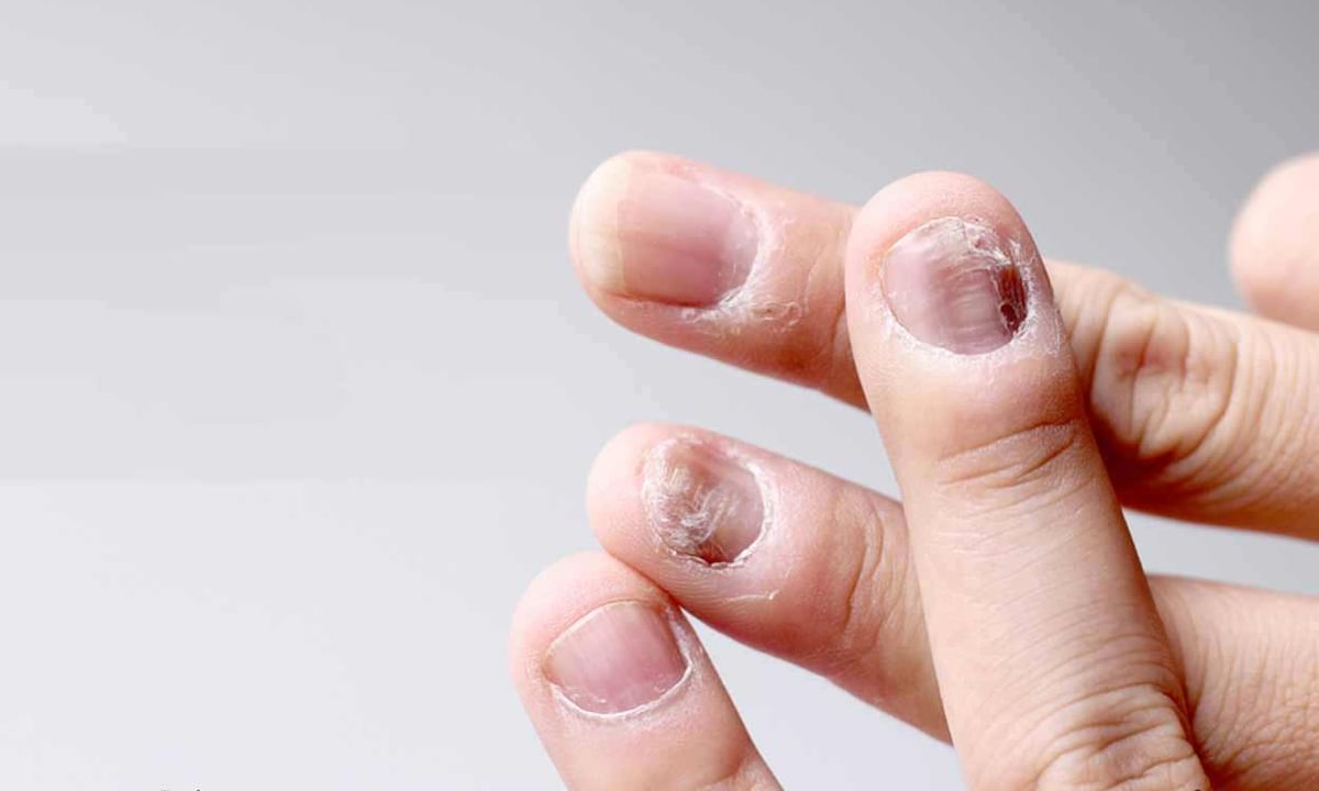 Broken Nails Tips & Advice From Top Doctors | Lybrate