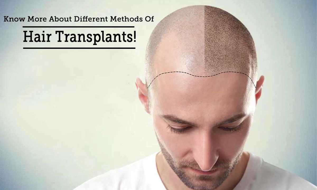 Fut Hair Transplant Tips & Advice From Top Doctors | Lybrate