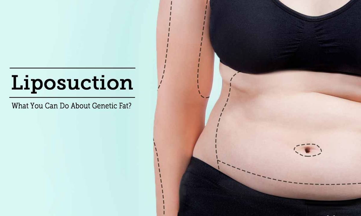 Health concerns that could merit the demand for Liposuction (ดูดไขมัน)