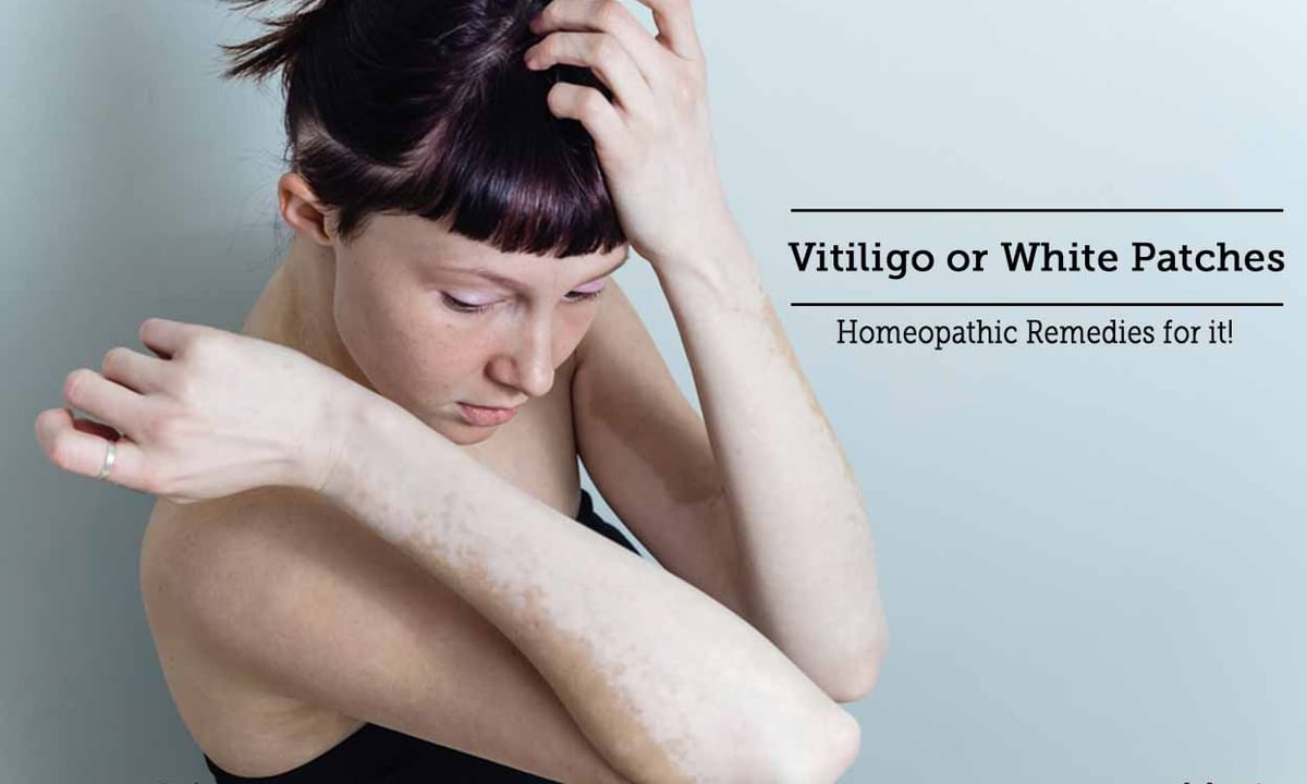 Homeopathic Medicine for Vitiligo or White Patches Treatment - By Dr.  Jeevan Kopparad | Lybrate