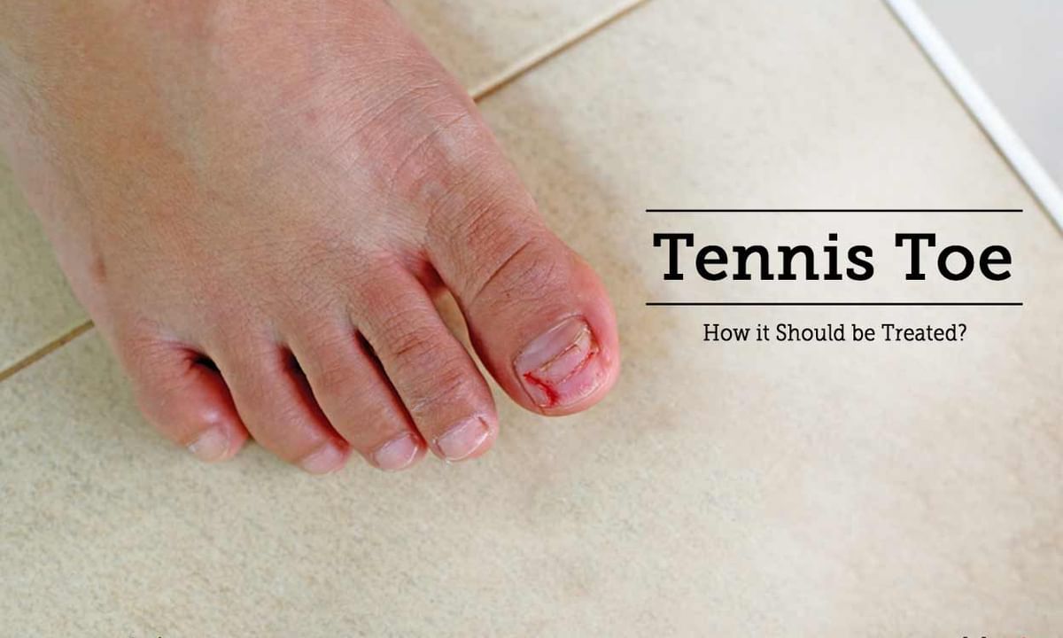 Tennis Toe - How it Should be Treated? - By Dr. Gurinder Bedi | Lybrate