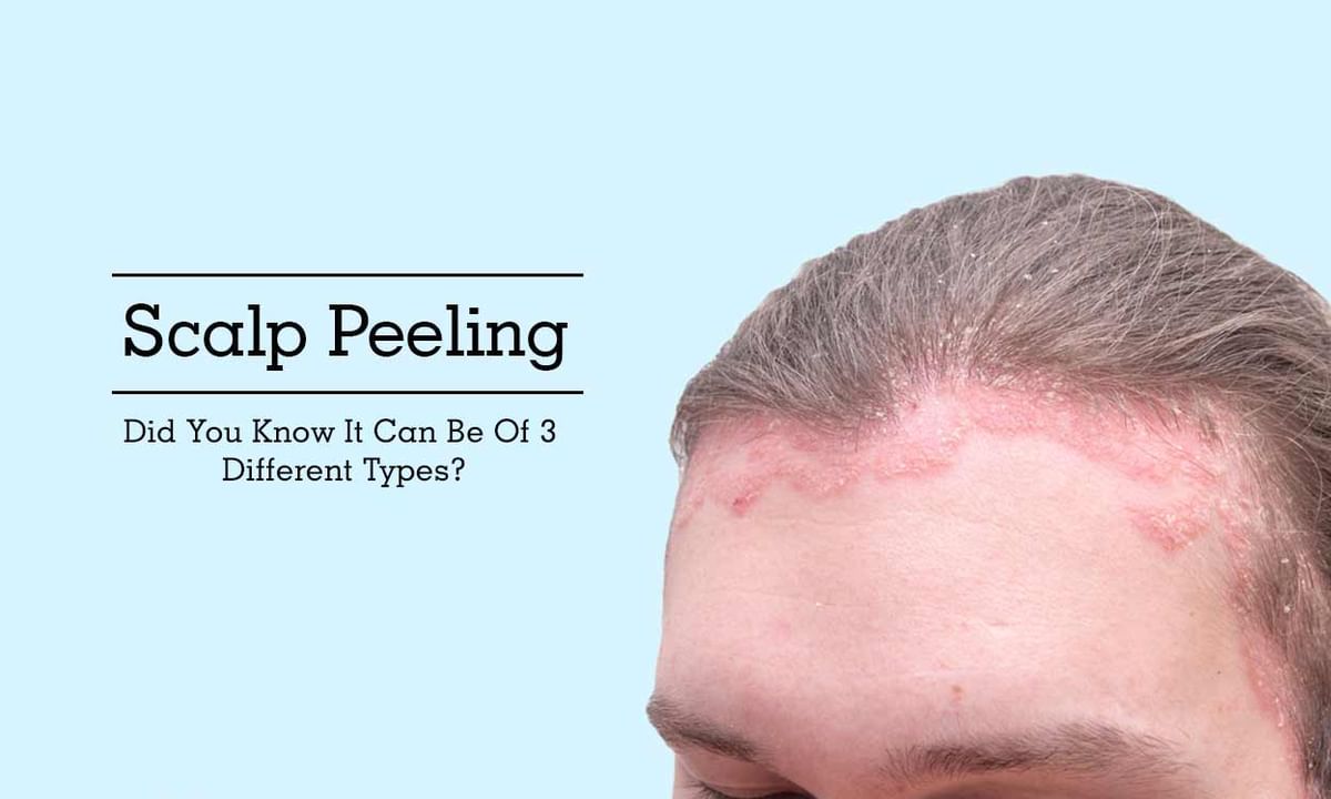 Scalp Peeling - It Can Be Of 3 Different Types? - By Looks Forever Hair And  Skin Aesthetic Clinic | Lybrate