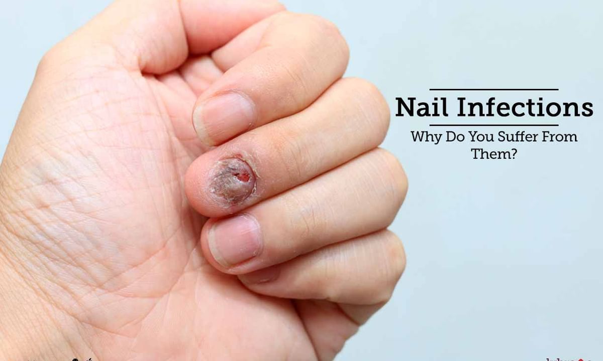 Nail Fungus Repair Spray Anti Fungal Ointement Damaged Nails Softening  Treatment Onychomycosis Remov | Lazada PH
