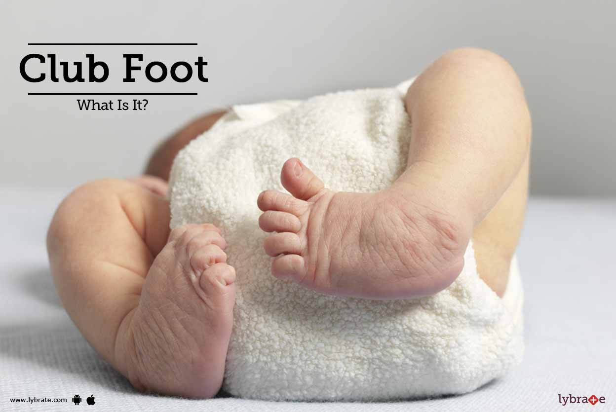 Club Foot What Is It By Dr Ravi Kant Gupta Lybrate