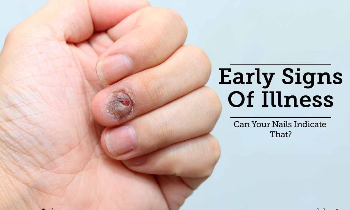 THIS is how lung cancer symptoms can show up on your fingernails: UK doctor  | Health News - Times Now
