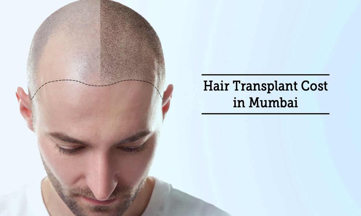 Hair Transplant Cost in Mumbai - By Dr. Sanjeev Kumar Singh | Lybrate