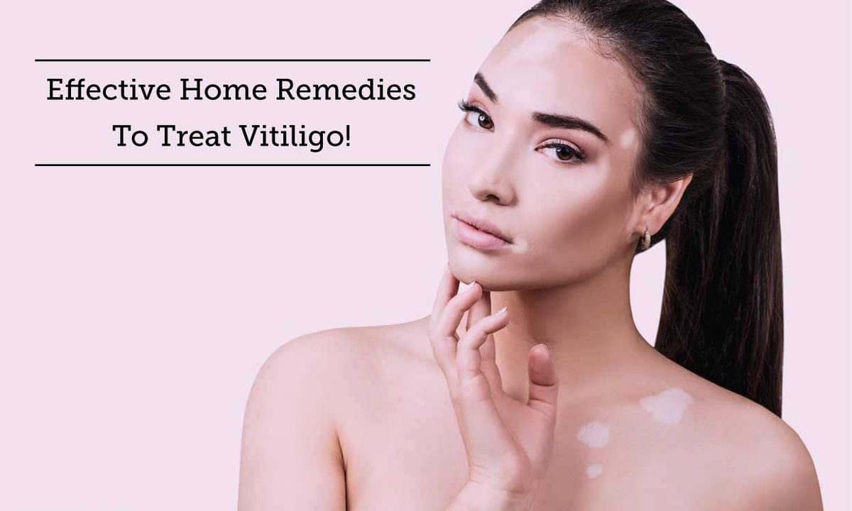 5 Best Home Remedies To Treat Vitiligo Diseases - By Dr. Ravish Kamal |  Lybrate