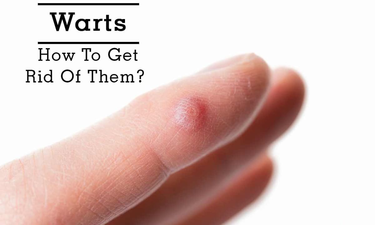 Skygge Alle I første omgang Top Health Tips on Treating Treating Genital Warts | Lybrate