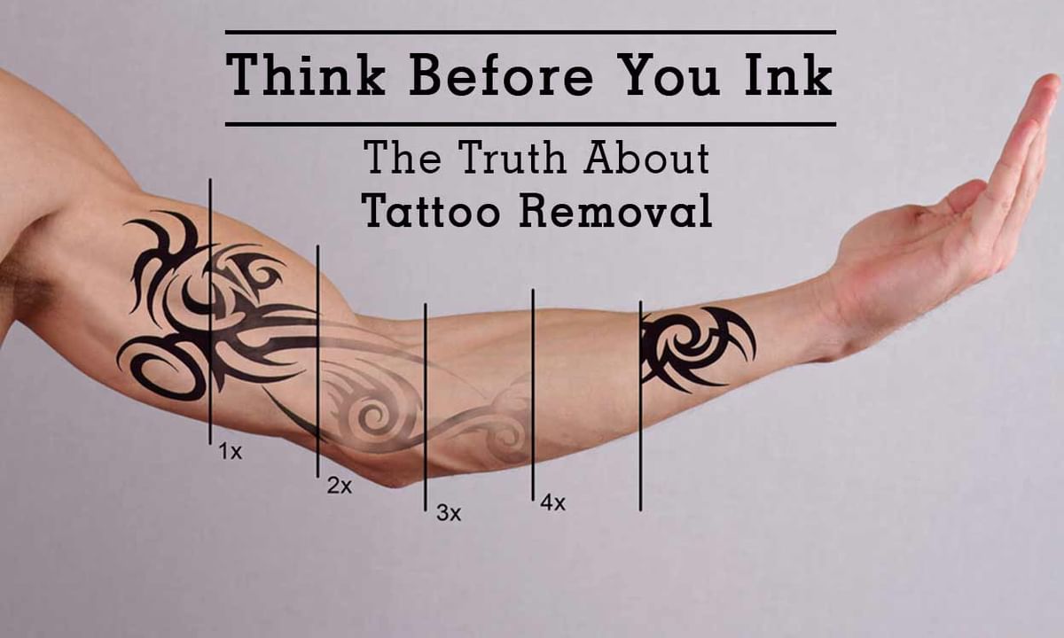 Tattoo Removal Before and After Pictures