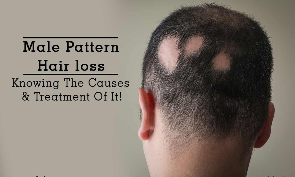 Male Pattern Hair loss - Knowing The Causes & Treatment Of It! - By Dr.  Ankuja Mhaske | Lybrate