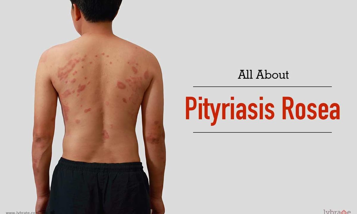 All About Pityriasis Rosea - By Dr. P. Phanisri | Lybrate