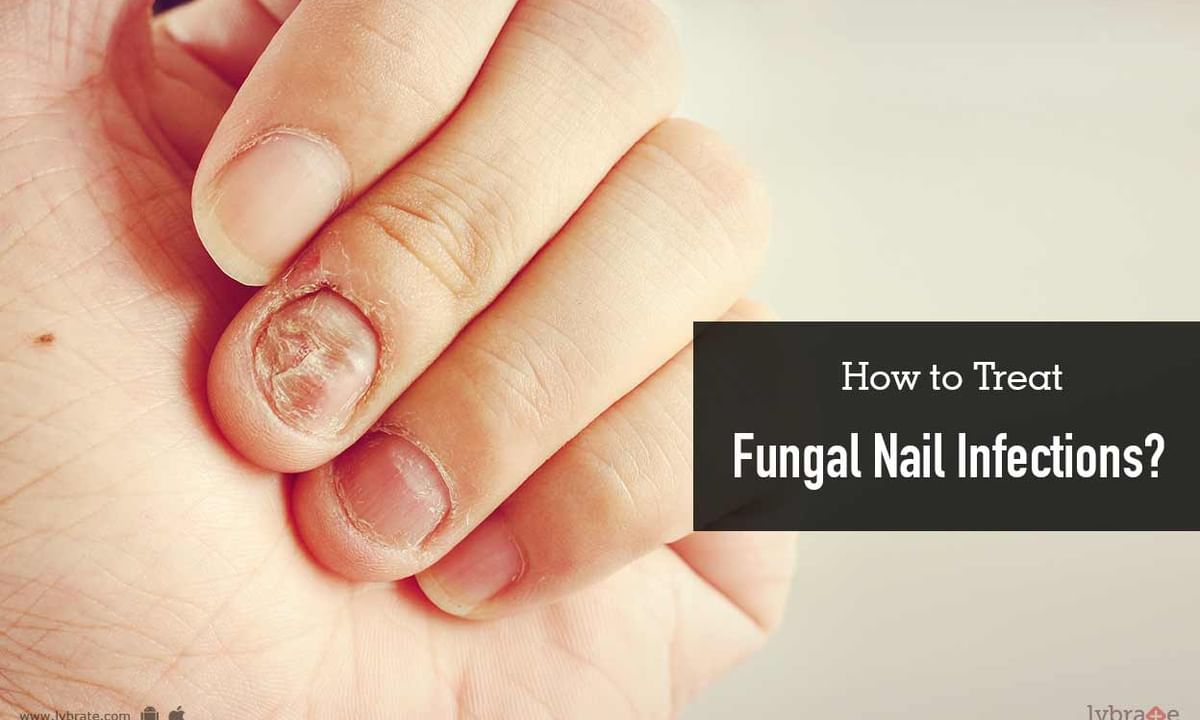 How to Treat Fungal Nail Infections? - By Dr. Akhilendra Singh | Lybrate