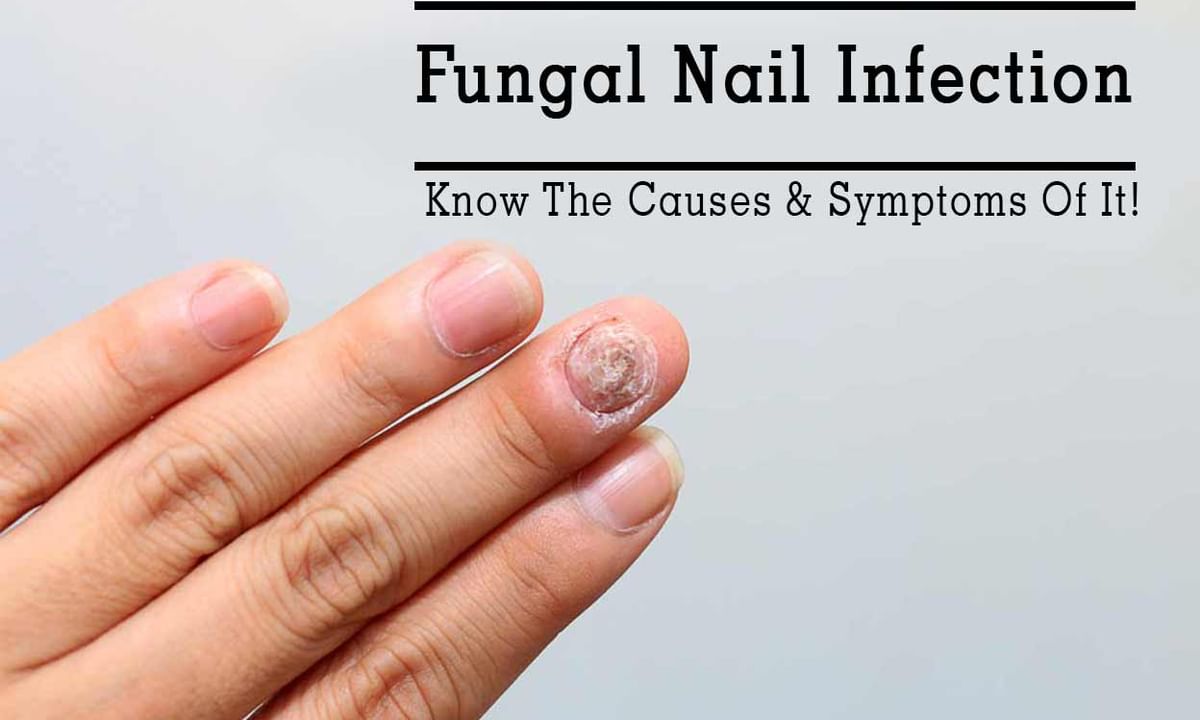 Top 131+ nail biting infection - ceg.edu.vn