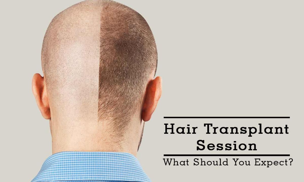 Hair Transplant Surgery Tips & Advice From Top Doctors | Lybrate
