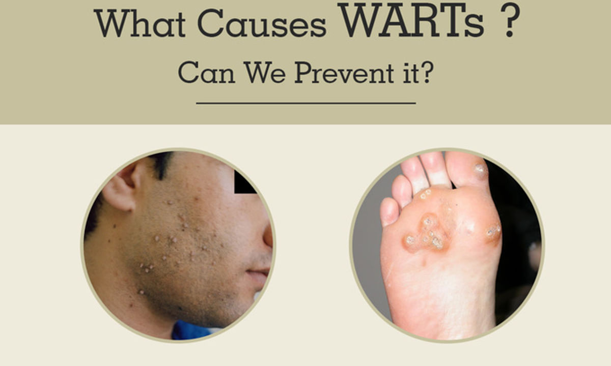 Warts And Plantar Warts | Healthlink Bc