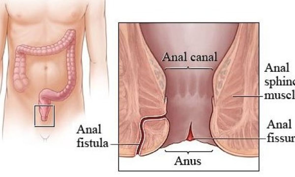 homeopathic remedy anal fissure porn photo