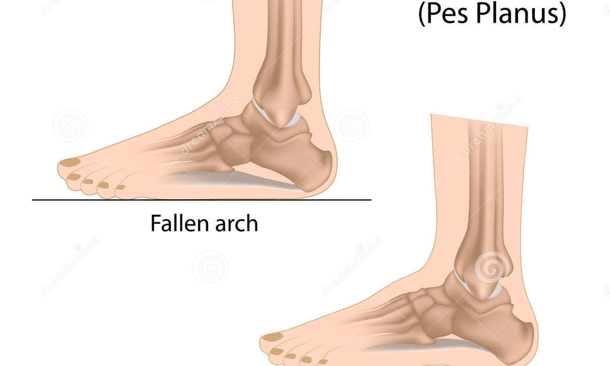 Footed meaning flat Flat feet