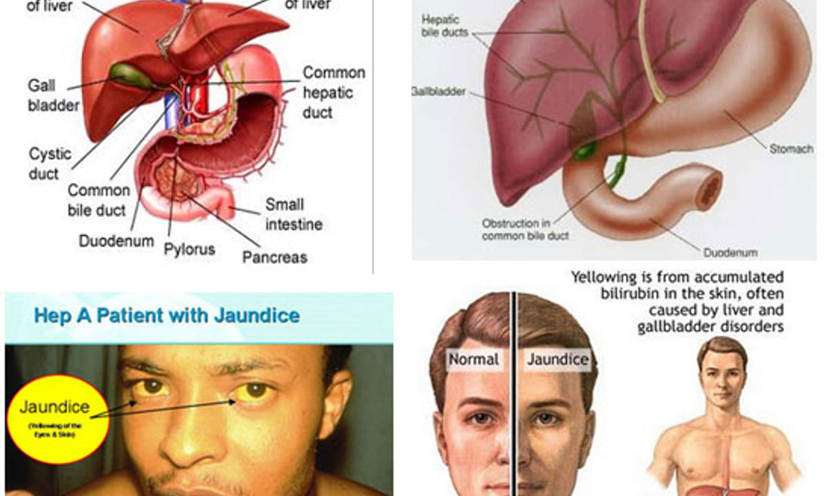 Understanding Jaundice (Kamala) - By Dr. Sushant Sud | Lybrate Understanding Jaundice (Kamala) - By Dr. Sushant Sud | Lybrate