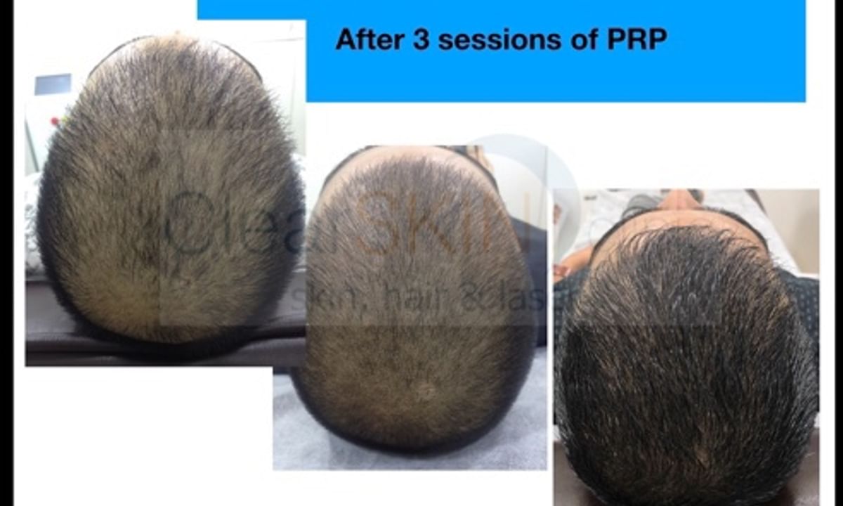 What Is PRP Hair treatment? - By Dr. Nikita Patel | Lybrate What Is PRP Hair treatment? - By Dr. Nikita Patel | Lybrate