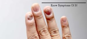Nail infection: Treatment, Procedure, Cost, Recovery, Side Effects And More Nail infection: Treatment, Procedure, Cost, Recovery, Side Effects And More