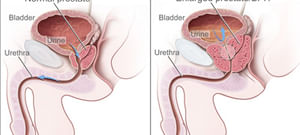 A prostatitis a tesztoszteron vízesés
