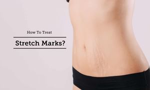 10 Ways to Get Rid of Stretch Marks