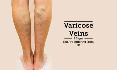 3 stage varicoză cum să tratați, Cum să tratați în mod eficient varicele pe picioare