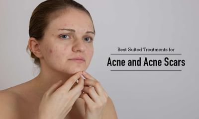 Best Suited Treatments For Acne And Acne Scars By Kaya Skin Clinic Lybrate I found all good and. acne scars by kaya skin clinic