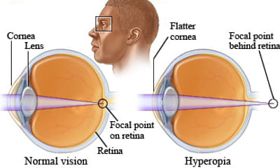 Hyperopia mint diagnózis, Látás diagnózis hyperopia A látás szempontjából fontos vitaminok