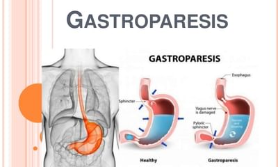 gastroparesis doctor near me)