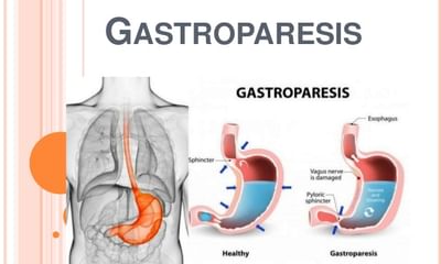 A septicus diabeteses láb sebészi kezelése - PDF Free Download