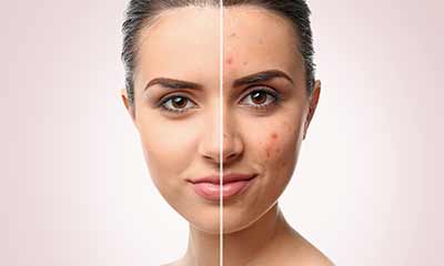 elidel crème rosacea